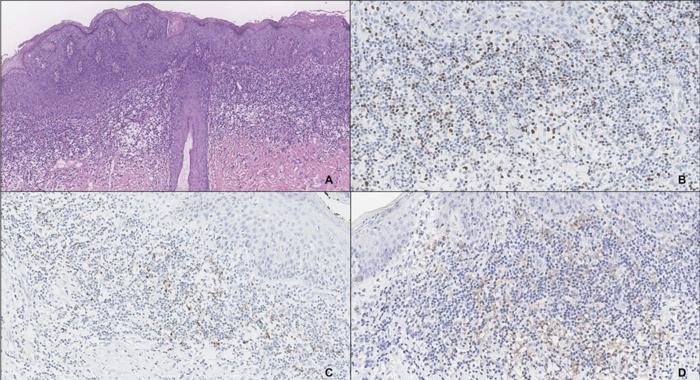 Anogenital Bölgedeki HPV İlişkili Prekanser Lezyonlarda Erken Bağışıklık Kaçışı