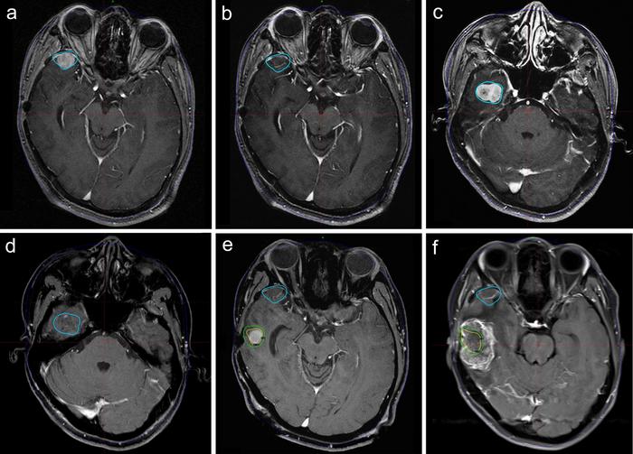 Grade 2 Meningiomlarda Gamma Knife Radyocerrahinin Yönetimdeki Rolü