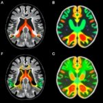 7T Mri Connectivity Enhances Parkinsons Dbs Targeting 1779973961