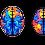 Brain Imaging Study Reveals Ethnoracial Variations In Dementia Risk And Progression 1779926865