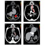 Comparing Sequential Transarterial Chemoembolization After Stereotactic Body Radiation Therapy To Radiation Alone In Treat...
