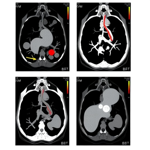 Comparing Sequential Transarterial Chemoembolization After Stereotactic Body Radiation Therapy To Radiation Alone In Treat...
