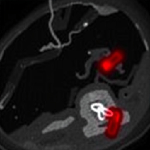 Deep Medullary Vein Thrombosis In Newborns Study 1779796886