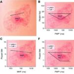 Epidermal Mhc Ii Drives Nk Cell Attack In Psoriasis 1778347242