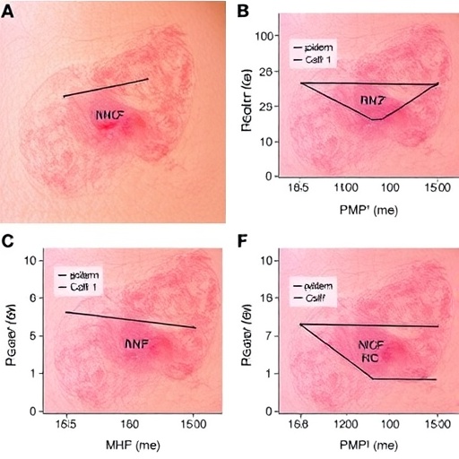 Epidermal Mhc Ii Drives Nk Cell Attack In Psoriasis 1778347242