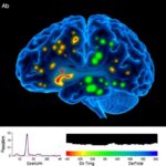 Human Oligodendrocyte Polarization Post Severe Brain Injury 1779929795