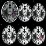 Mri And Transcriptomics Uncover Parkinsons Neurodegeneration Links 1779820110