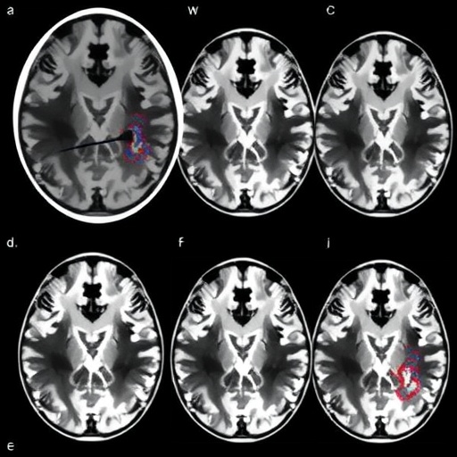 Mri And Transcriptomics Uncover Parkinsons Neurodegeneration Links 1779820110