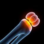 New Drug Trial Suggests Change In Treatment Approach For Brittle Bone Disease 1778778945