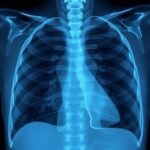 New Study Finds Simple X Ray Metric Predicts Survival In Lung Cancer Surgery Patients 1778687306