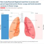 New Study Reveals Regional Disparities In Access To Donor Lungs And Transplant Opportunities 1779913531