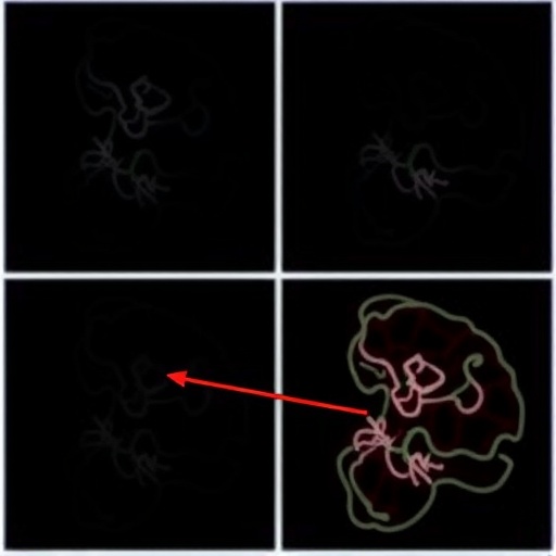Oligometastatic Prostate Cancer Linking Local And Metastatic 1778095367