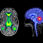 Personalized Ai Guided Radiation Boosts Glioblastoma Treatment 1778707223