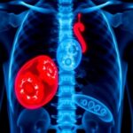 Screening Leads To Moderate Reduction In Prostate Cancer Mortality 1778803831