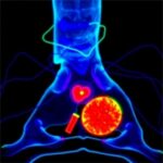 Active Β Catenin Drives Aggressiveness In Pediatric Osteosarcoma Study Finds 1781028447