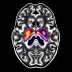 Dti Alps And Choroid Plexus Linked To Parkinsons Severity 1781191712