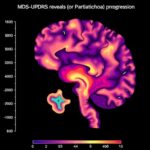 Denoised Mds Updrs Reveals New Parkinsons Progression Patterns 1781224782