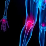 Dual Amylin Calcitonin Agonists Osteoarthritis Game Changers 1781023413