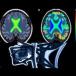 Enhancing Cns Tumor Therapy With Mri Guided Ultrasound 1781565091