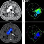 Il11 Drives Lung Cancer Metastasis Through Mmp12 Pathway 1781174378