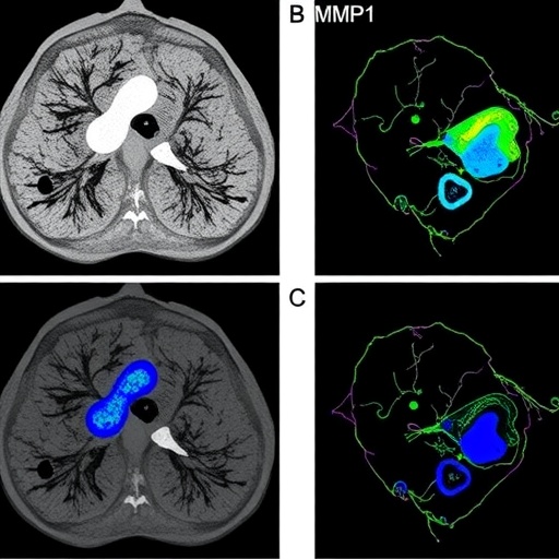 Il11 Drives Lung Cancer Metastasis Through Mmp12 Pathway 1781174378