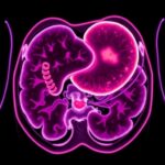 Infigratinib Shows Promise For Fgfr2 Positive Gastric Cancer 1782206316