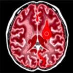 Inflammation Resolution Failure In Intracerebral Hemorrhage 1782247780