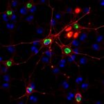 Neurofilament Light Gfap Biomarkers For Postoperative Delirium 1780627653