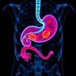 New Tomography Based Marker Advances Accuracy Of Gastric Cancer Prognosis 1781648182