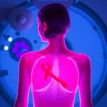 Radiotherapy And Skin Cancer Risk In Breast Cancer 1781312187