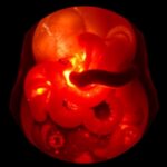 Rare Intestinal Tumor Mimicking Intussusception Sheds Light On Diagnostic Challenges In Young Women 1781126002