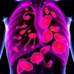 Scientists At Cdi Uncover How Fat Tissue May Drive Triple Negative Breast Cancer Spread Opening Doors To New Treatments 17...