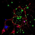 Single Cell Sequencing Uncovers Burkitt Lymphoma Evolution 1780955071