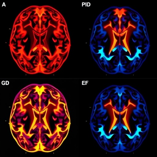 Striatal Hyperechogenicity Signals Early Xdp Detection 1780475377