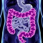 Tumour Deposits Drive Immune Evasion Worsen Colorectal Prognosis 1781276064
