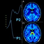 Neuroimaging Reveals Nigrostriatal Decline Gradient In Parkinsons 1782910236