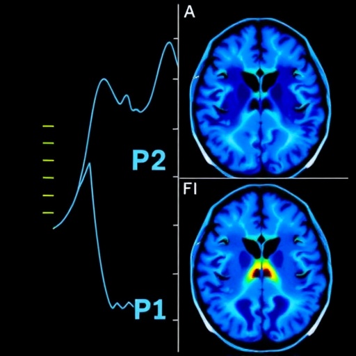 Neuroimaging Reveals Nigrostriatal Decline Gradient In Parkinsons 1782910236