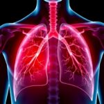 New Expert Guidelines Enhance Detection And Management Of Lung Disease In Rheumatoid Arthritis Patients 1782943416