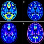 Aktif GPi derin beyin stimülasyonunda hedefe bağlı beyin ağları fMRI ile haritalandı