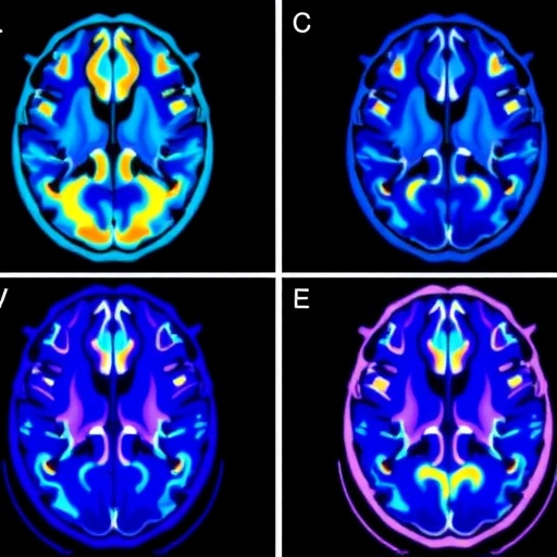 Aktif GPi derin beyin stimülasyonunda hedefe bağlı beyin ağları fMRI ile haritalandı