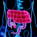 Bağırsak bakterisi indol metabolitleriyle melanoma karşı bağışıklığı güçlendirebilir
